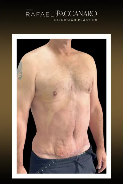 abdominoplastia depois