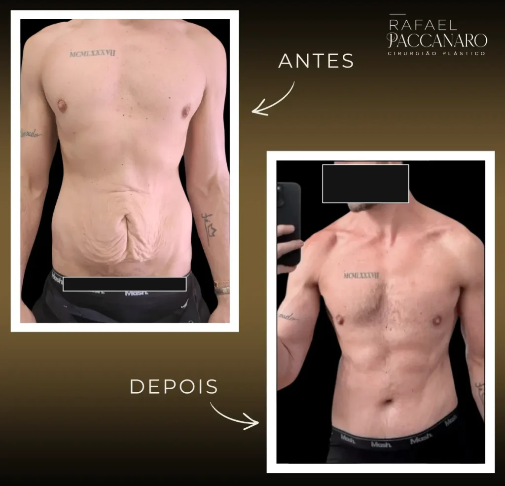 abdominoplastia masculina
